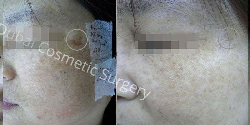 Skin Whitening Before And After 1