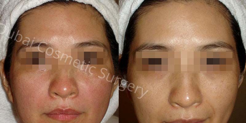 Skin whitening Before And after 5