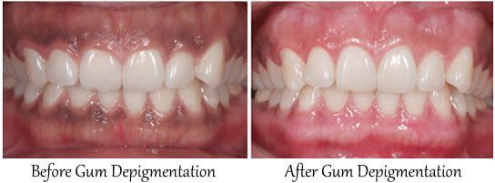Gum Depigmentation