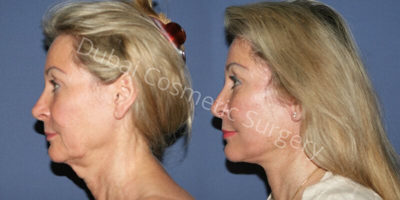 Neck Lift Before and After 3