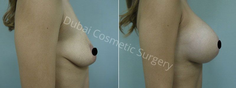 Breast Lift Surgery - Mastopexy in Dubai