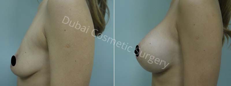 Breast Lift Dubai - Mastopexy Surgery