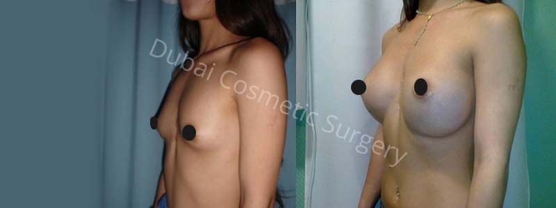 Breast Lift Dubai - Mastopexy Surgery