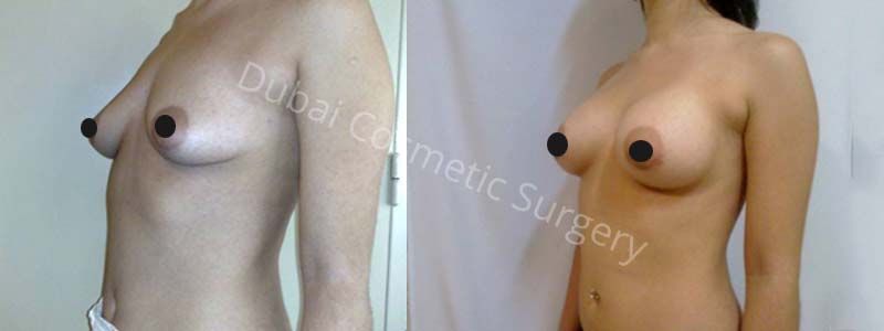 Breast Lift Surgery Dubai