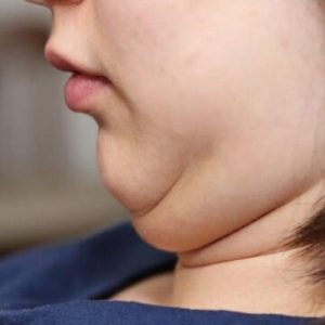 Double Chin Liposuction