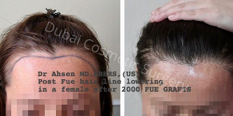 Female Hair transplant before & After 8