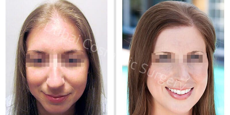 Female Hair transplant before & After 9