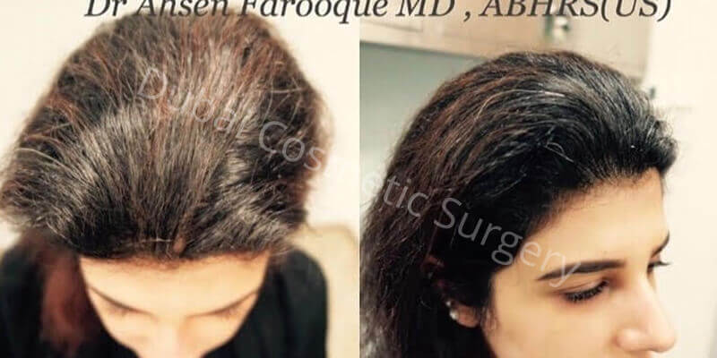 Female Hair transplant before & After 10