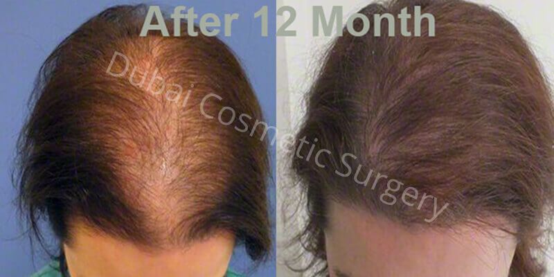 Female Hair transplant before & After 11