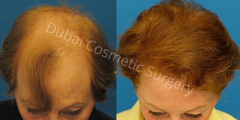 Female Hair transplant before & After 12