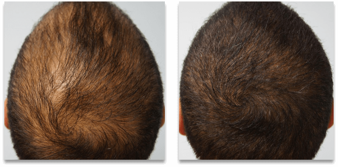 Hair transplant before after1