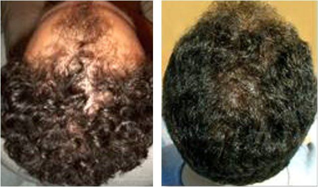 Hair transplant before after 8