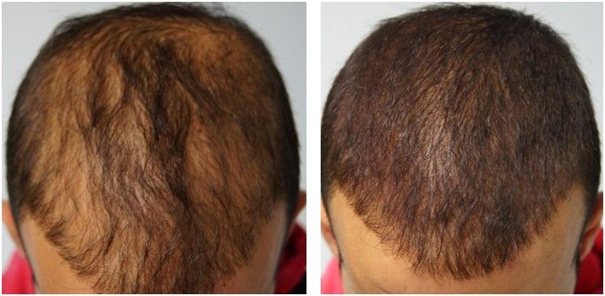 Hair transplant before after 5