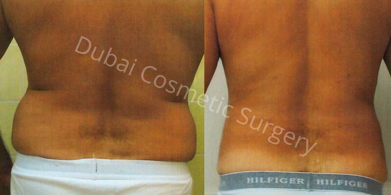 Liposuction before after 1