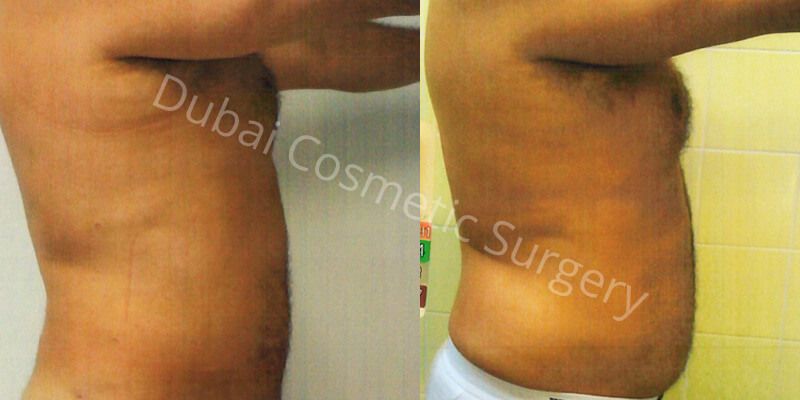 Liposuction before after 2