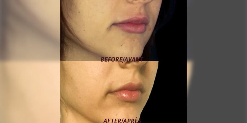 Lip Augmentation Before and After 2