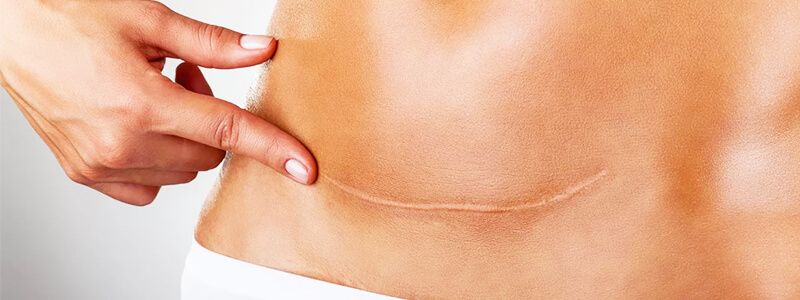 Best Treatments for Abdominoplasty Scars
