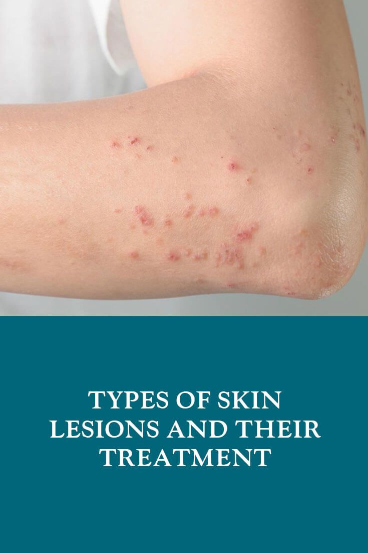 Skin Lesions Types and Treatment | Dubai Cosmetic Surgery®