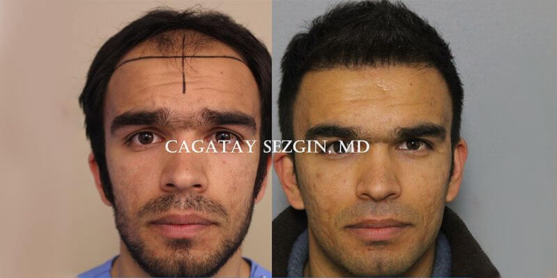 Dr. Cagatay Sezgin Hair Transplant