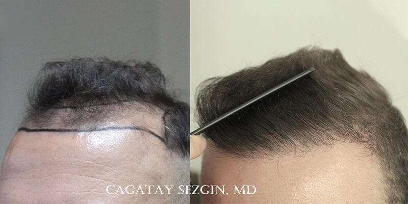 Dr. Cagatay Sezgin Hair Transplant