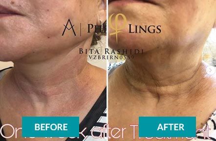 Microneedling before & after 13