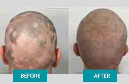 Scalp MicroPigmentation before & after 2