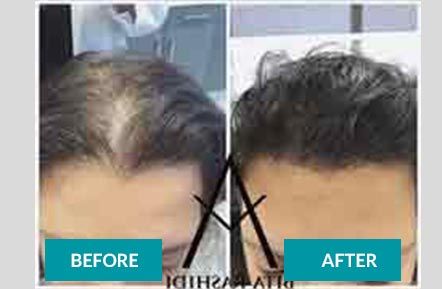 Scalp MicroPigmentation before & after 3