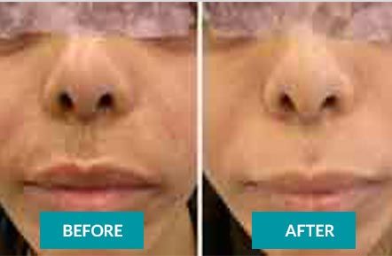 Microneedling before & after 5