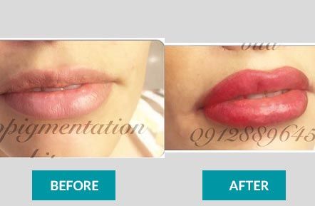 Microneedling before & after 6
