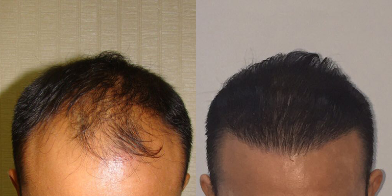 Hair Transplant before & After