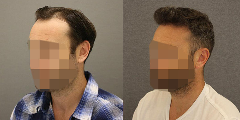 Hair Transplant before & After