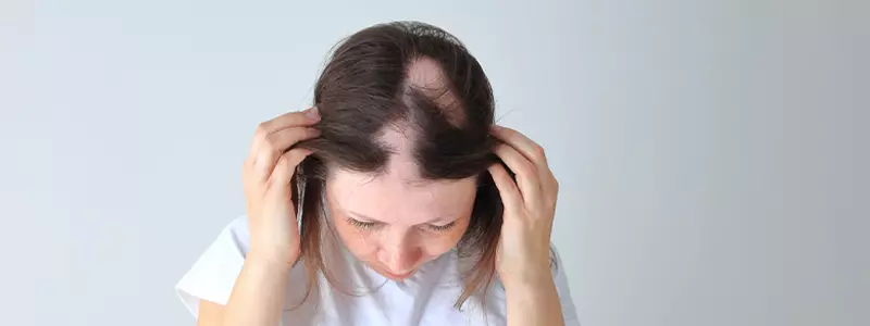 4 Causes of Alopecia in Females