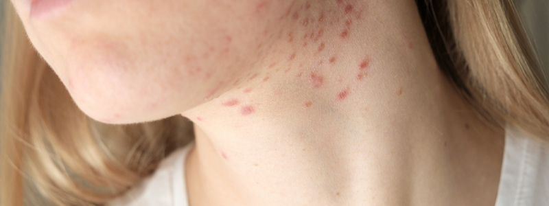 pimples on neck